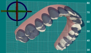 invisalign - computergestuetzte Simulation der Zahnbewegungen