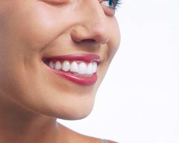 invisalign aligner - unsichtbare Zahnspange im Mund