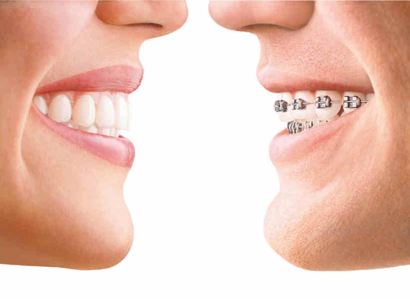 invisalign im optischen Vergleich zu einer festen Zahnspange
